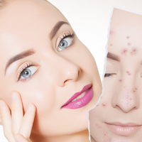 Miel de Manuka para el acné - foto de antes y después de una mujer con acné