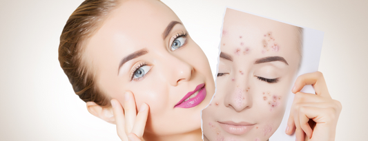 Miel de Manuka para el acné - foto de antes y después de una mujer con acné